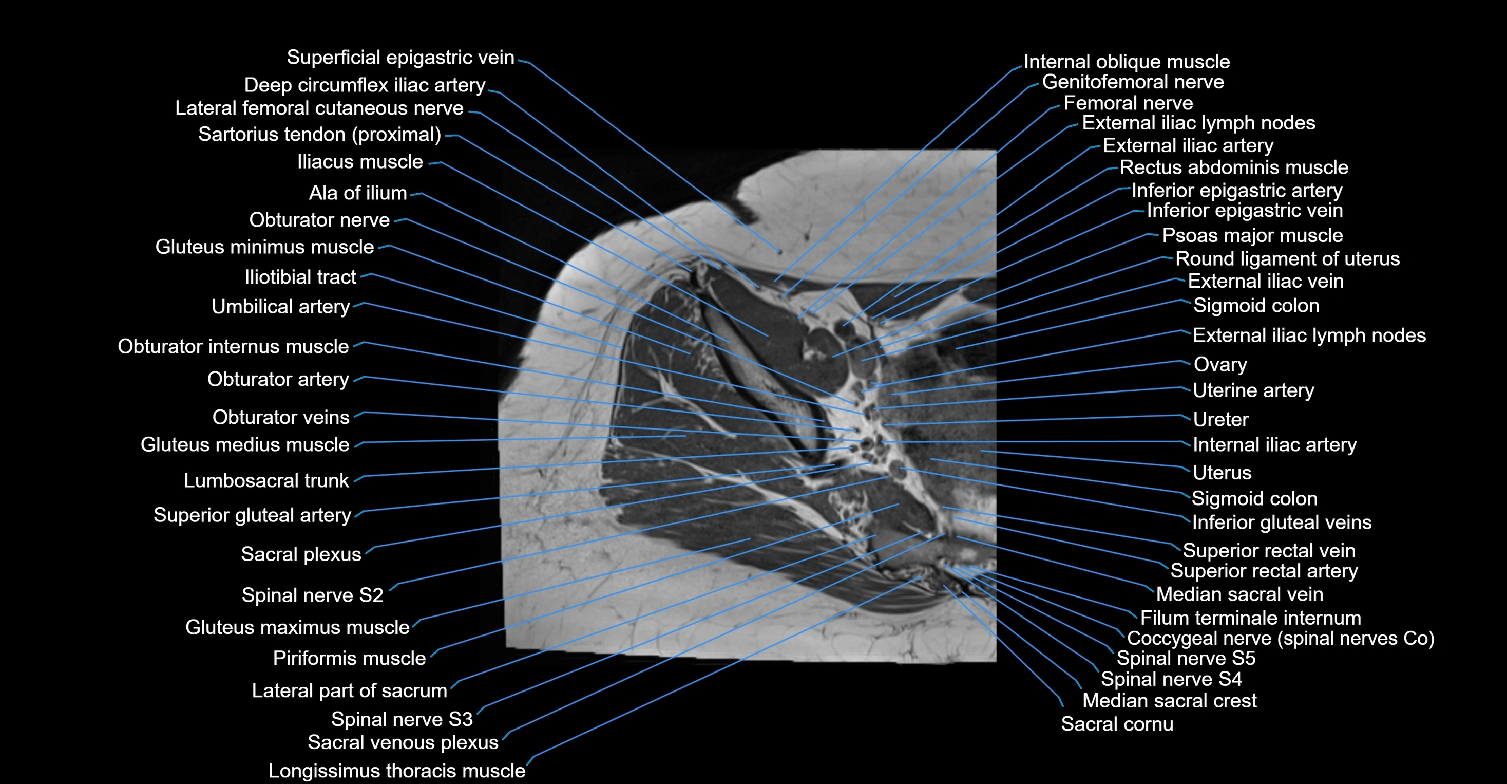 MRI hip axial cross sectional anatomy 3T 3D  radiology  anatomy image-img-00001-00010.webp